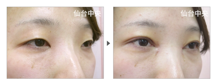26歳、女性。離れ目治療 症例写真 症例写真2