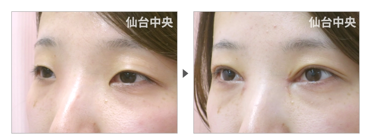 26歳、女性。離れ目治療 症例写真 症例写真3