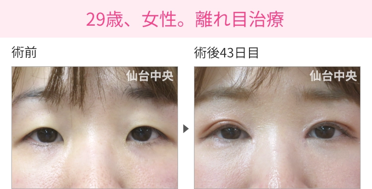 29歳、女性。離れ目治療 症例写真 症例写真1