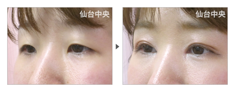 29歳、女性。離れ目治療 症例写真 症例写真3