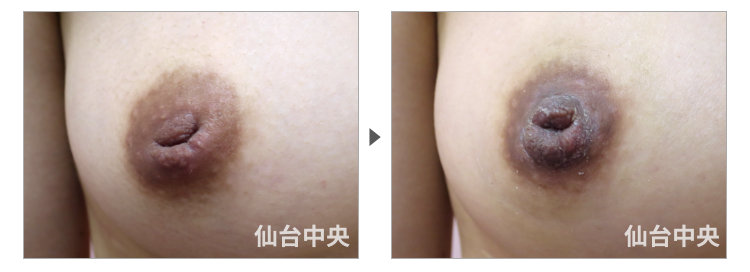 31歳、既婚。陥没乳頭 症例写真2