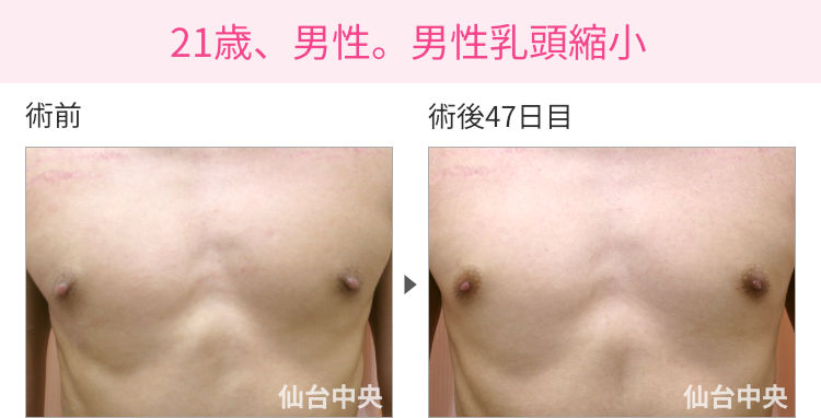 21歳、男性。男性乳頭縮小 症例写真1
