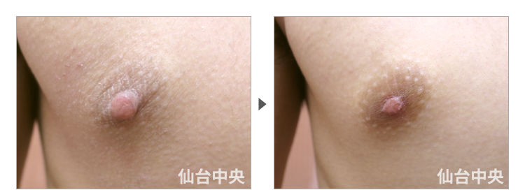 21歳、男性。男性乳頭縮小 症例写真2