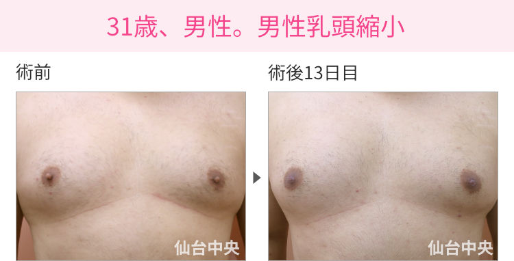 31歳、男性。男性乳頭縮小 症例写真1