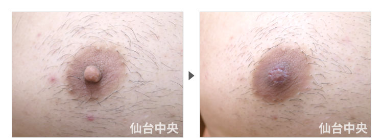 31歳、男性。男性乳頭縮小 症例写真2