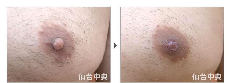 31歳、男性。男性乳頭縮小 症例写真3