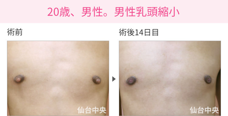 20歳、男性。男性乳頭縮小 症例写真1