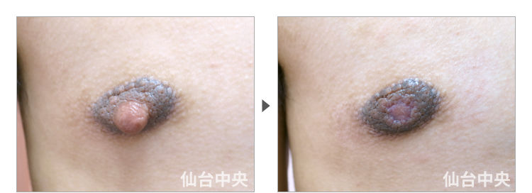 20歳、男性。男性乳頭縮小 症例写真2