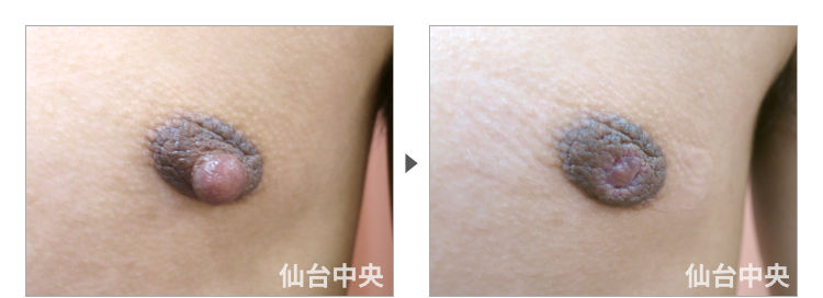 20歳、男性。男性乳頭縮小 症例写真3