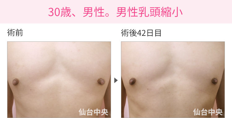 30歳、男性。男性乳頭縮小 症例写真1