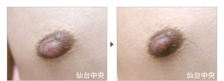 30歳、男性。男性乳頭縮小 症例写真2