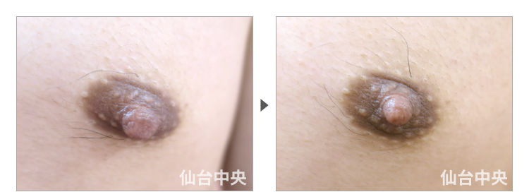 30歳、男性。男性乳頭縮小 症例写真3