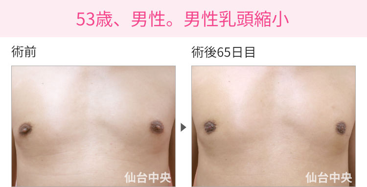 53歳、男性。男性乳頭縮小 症例写真1