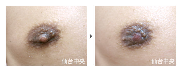 53歳、男性。男性乳頭縮小 症例写真2