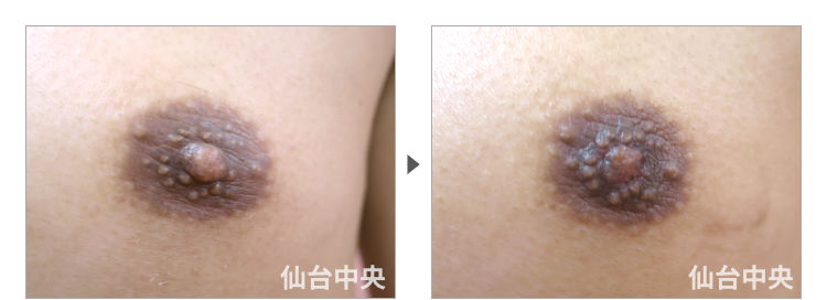 53歳、男性。男性乳頭縮小 症例写真3