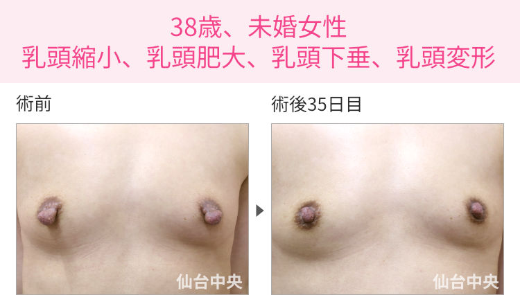 38歳、未婚女性。乳頭縮小、乳頭肥大、乳頭下垂、乳頭変形 症例写真1