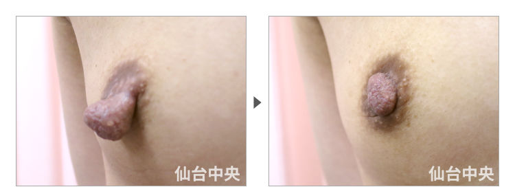 38歳、未婚女性。乳頭縮小、乳頭肥大、乳頭下垂、乳頭変形 症例写真2