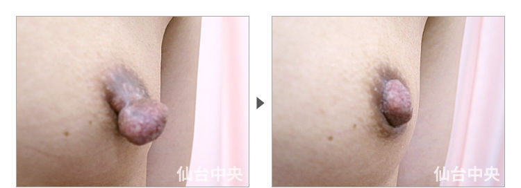 38歳、未婚女性。乳頭縮小、乳頭肥大、乳頭下垂、乳頭変形 症例写真3