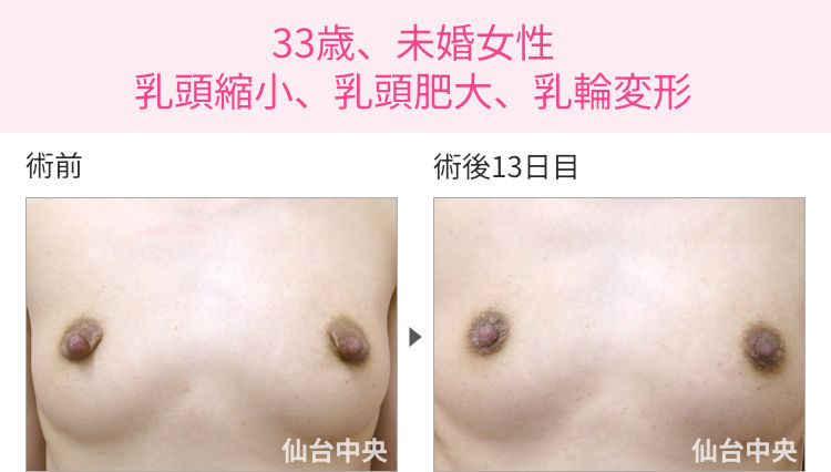 33歳、未婚女性。乳頭縮小、乳頭肥大、乳輪変形 症例写真1