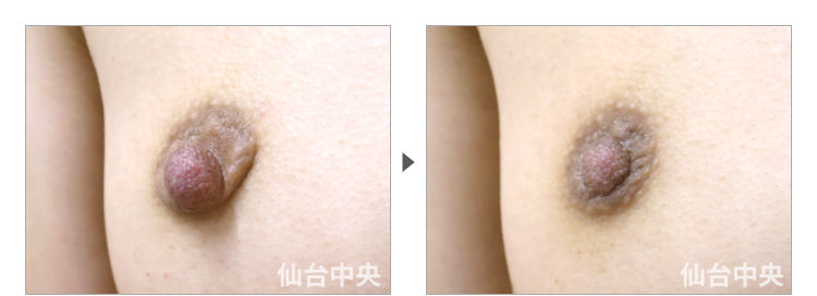 33歳、未婚女性。乳頭縮小、乳頭肥大、乳輪変形 症例写真2
