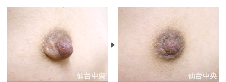 33歳、未婚女性。乳頭縮小、乳頭肥大、乳輪変形 症例写真3