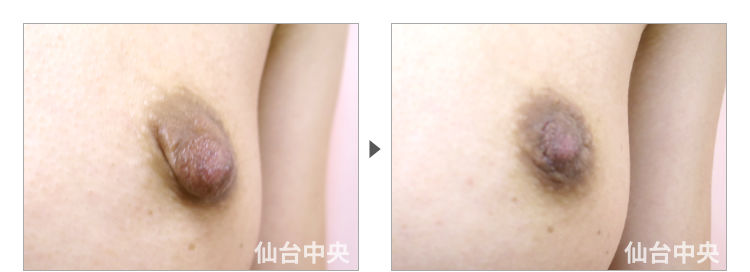 33歳、未婚女性。乳頭縮小、乳頭肥大、乳輪変形 症例写真4