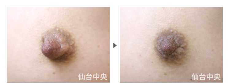 33歳、未婚女性。乳頭縮小、乳頭肥大、乳輪変形 症例写真5