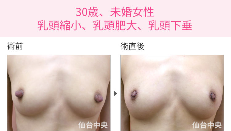 30歳、未婚女性。乳頭縮小、乳頭肥大、乳頭下垂 症例写真1