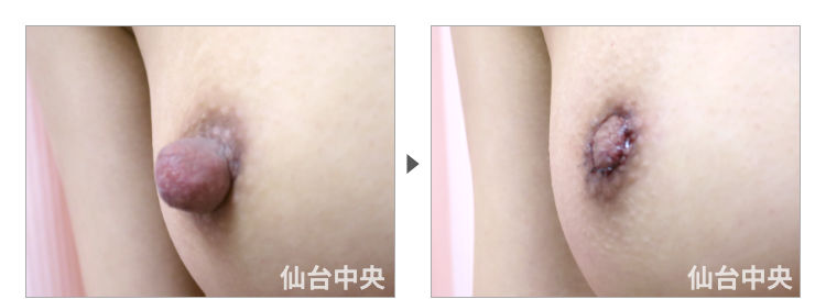 30歳、未婚女性。乳頭縮小、乳頭肥大、乳頭下垂 症例写真2