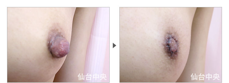 30歳、未婚女性。乳頭縮小、乳頭肥大、乳頭下垂 症例写真3