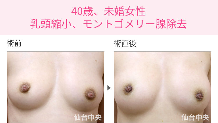40歳、未婚女性。乳頭縮小、モントゴメリー腺除去 症例写真1