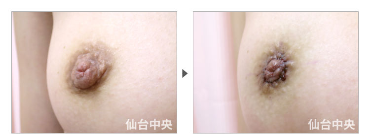 40歳、未婚女性。乳頭縮小、モントゴメリー腺除去 症例写真2