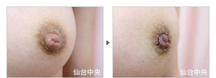 40歳、未婚女性。乳頭縮小、モントゴメリー腺除去 症例写真3