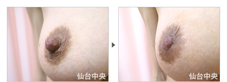 44歳、既婚女性。妊娠出産授乳後の乳頭縮小、乳頭肥大 症例写真2