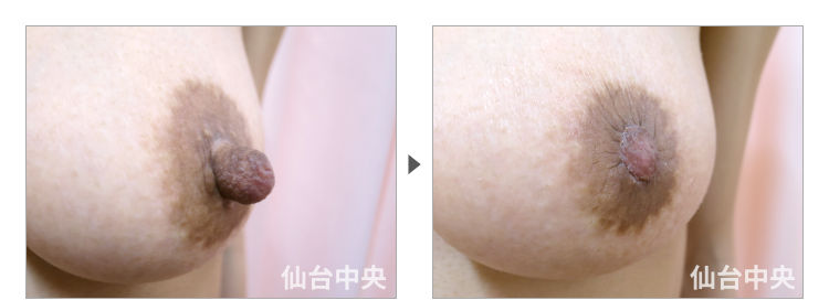 44歳、既婚女性。妊娠出産授乳後の乳頭縮小、乳頭肥大 症例写真3