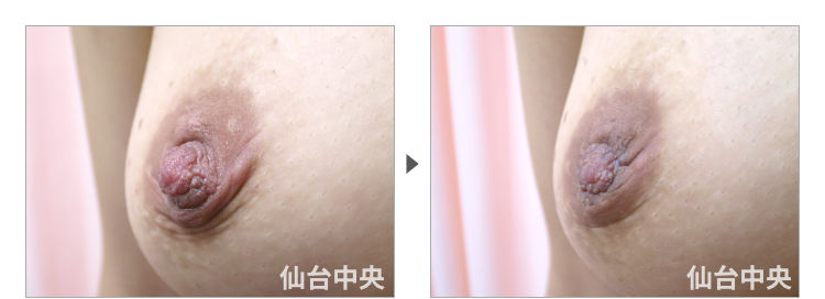 31歳、既婚女性。妊娠出産授乳後の乳頭縮小、乳頭肥大、乳頭変形、乳輪変形 症例写真2
