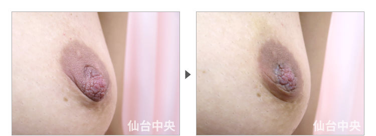 31歳、既婚女性。妊娠出産授乳後の乳頭縮小、乳頭肥大、乳頭変形、乳輪変形 症例写真3