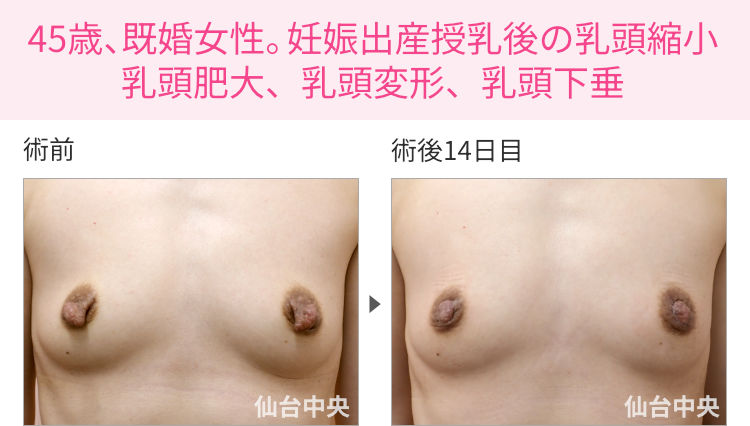 45歳、既婚女性。妊娠出産授乳後の乳頭縮小、乳頭肥大、乳頭変形、乳頭下垂 症例写真1