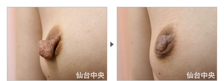 45歳、既婚女性。妊娠出産授乳後の乳頭縮小、乳頭肥大、乳頭変形、乳頭下垂 症例写真2