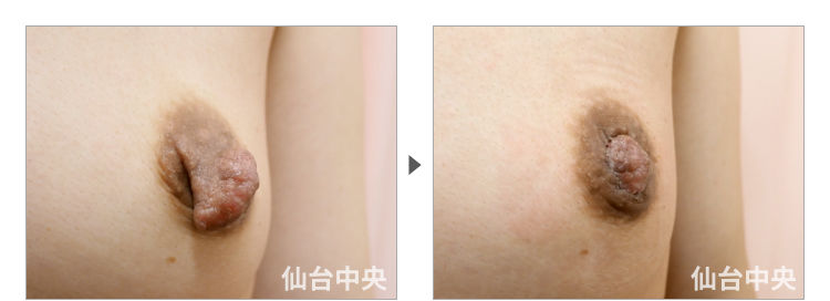 45歳、既婚女性。妊娠出産授乳後の乳頭縮小、乳頭肥大、乳頭変形、乳頭下垂 症例写真3