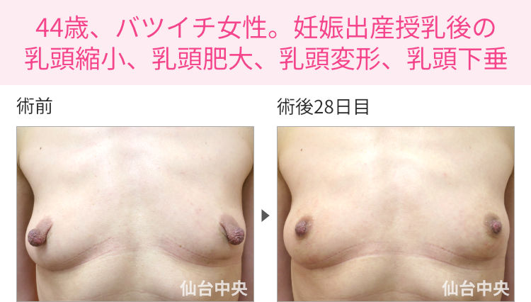 44歳、バツイチ女性。妊娠出産授乳後の乳頭縮小、乳頭肥大、乳頭変形、乳頭下垂 症例写真1