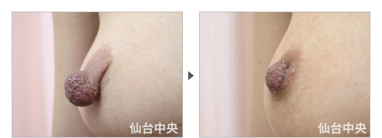 44歳、バツイチ女性。妊娠出産授乳後の乳頭縮小、乳頭肥大、乳頭変形、乳頭下垂 症例写真2