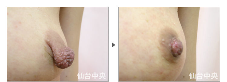 44歳、バツイチ女性。妊娠出産授乳後の乳頭縮小、乳頭肥大、乳頭変形、乳頭下垂 症例写真3