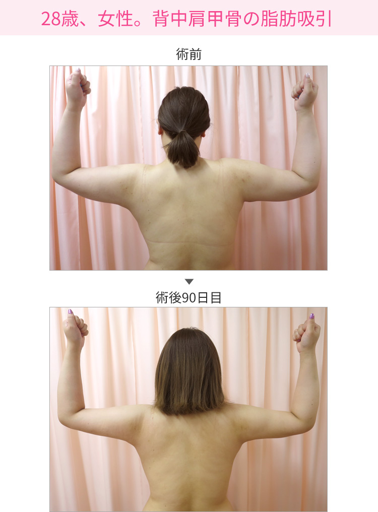 28歳、女性。背中肩甲骨の脂肪吸引 症例写真1