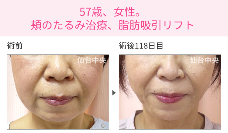 57歳、女性。頬のたるみ治療、脂肪吸引リフト 症例写真1