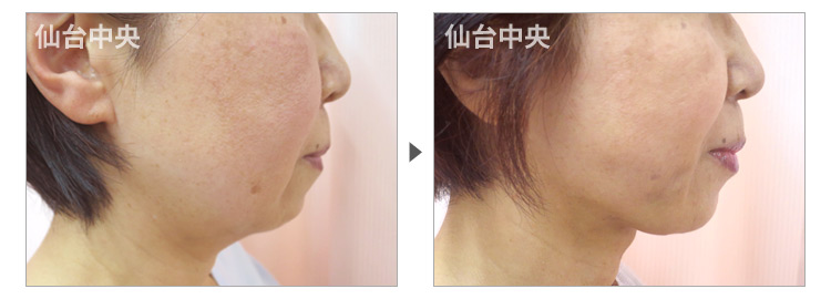 57歳、女性。頬のたるみ治療、脂肪吸引リフト 症例写真4