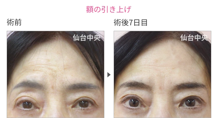 額の引き上げ 症例写真6