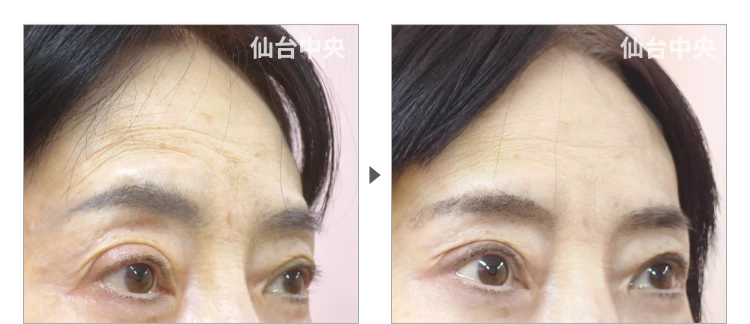 額の引き上げ 症例写真7