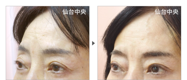 額の引き上げ 症例写真8