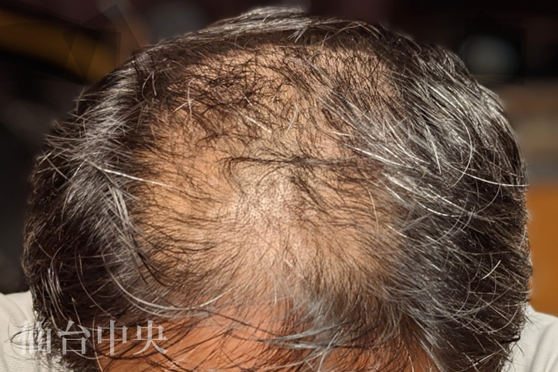 進行した薄毛に対し治療を考える男性